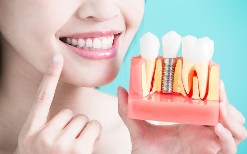 A Look at How Dental Implants Are More Than Just a Cosmetic Choice